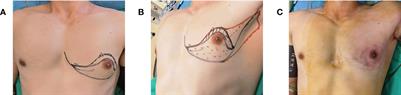 Trans-axillary single port insufflation technique-assisted endoscopic surgery for breast diseases: Clinic experience, cosmetic outcome and oncologic result